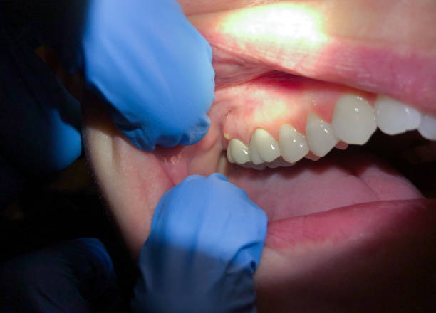 Tooth Infection Emergency Dentist in GA